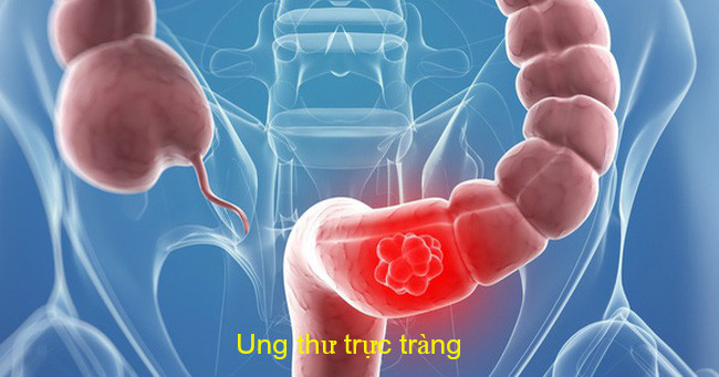 nguyen-nhan-dan-den-ung-thu-truc-trang